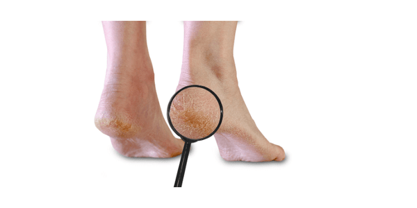 magnifying glass showing dry cracked heels on white background 